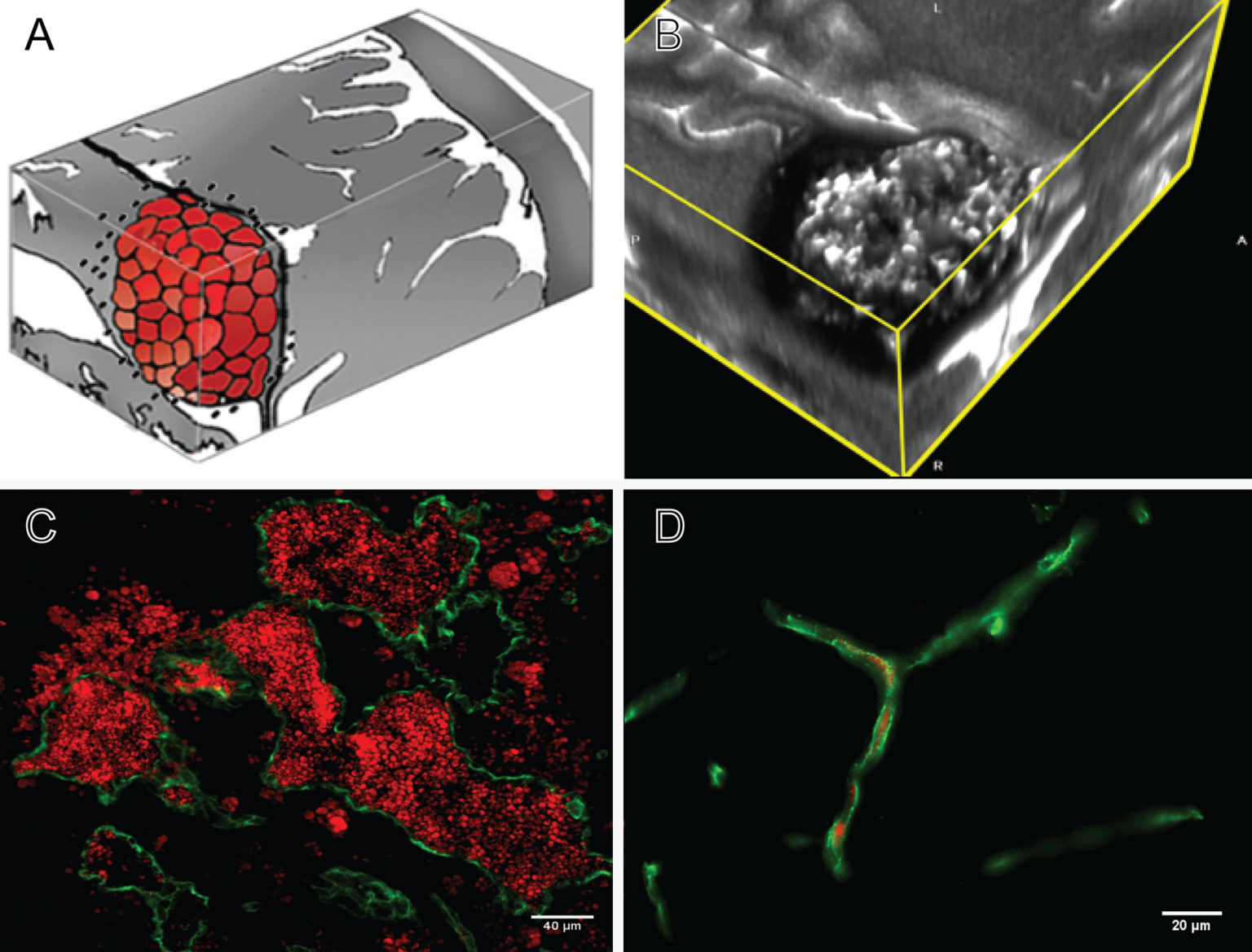 Cavernous Malformation Biology Alliance To Cure Cavernous Malformation