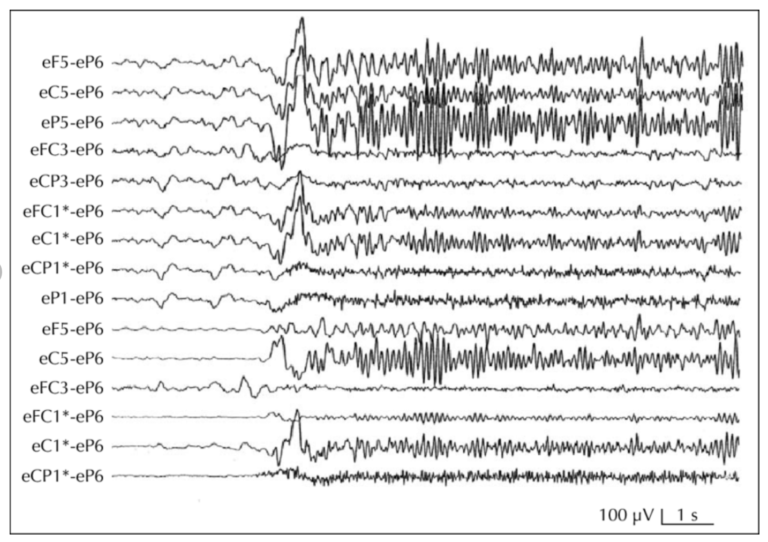 Seizure - Alliance to Cure Cavernous Malformation