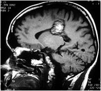 MRI Image Large Cavernous Angioma Lesion