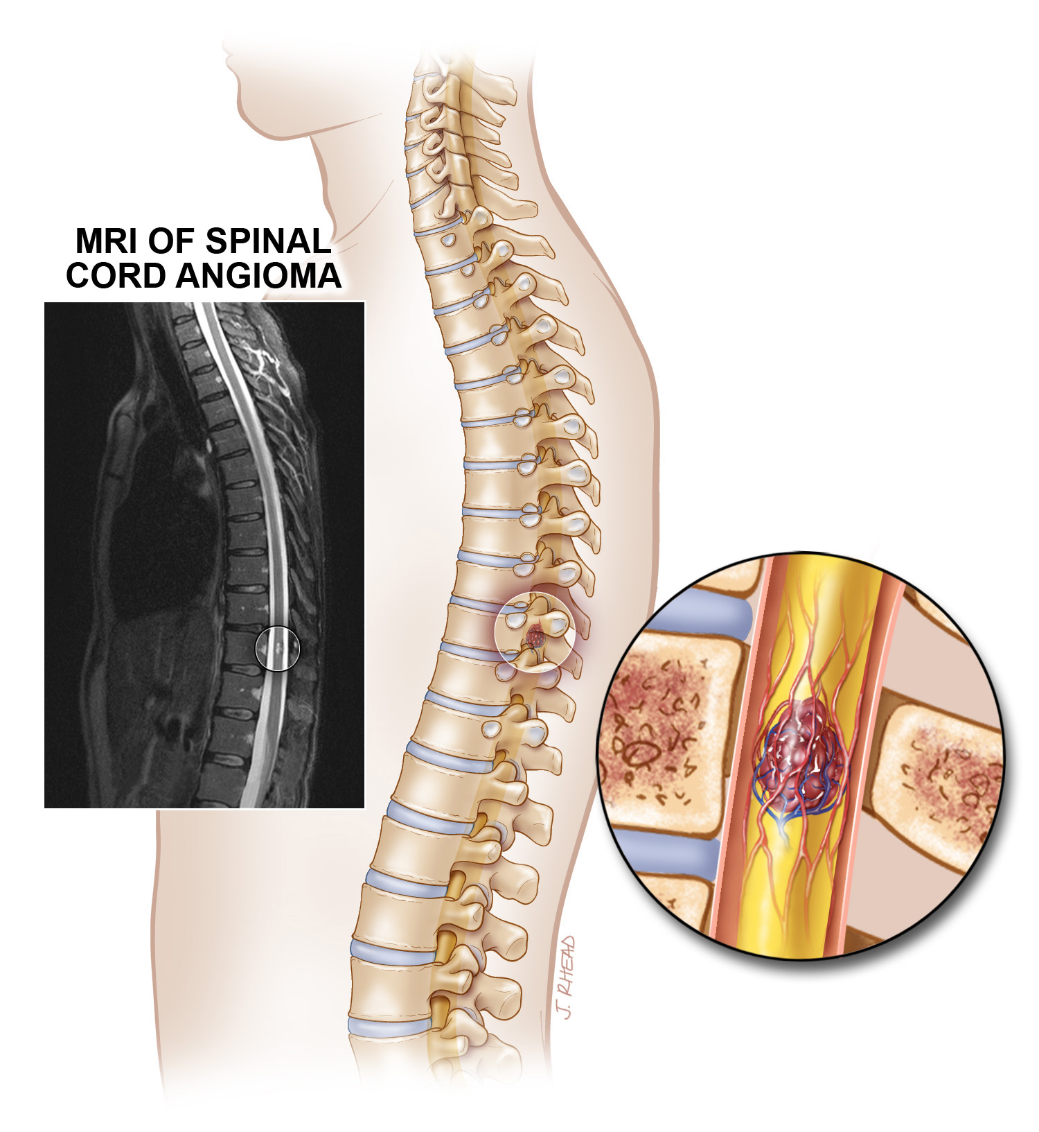 MRI of Spinal cord cavernous malformation