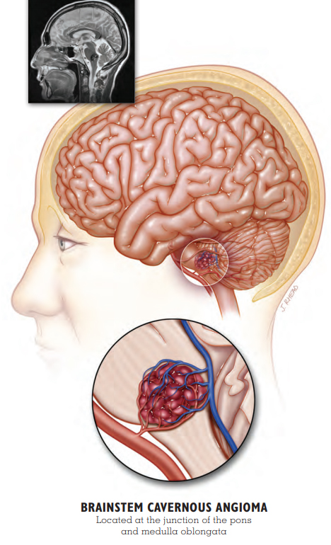 Brainstem Cavernous Angioma